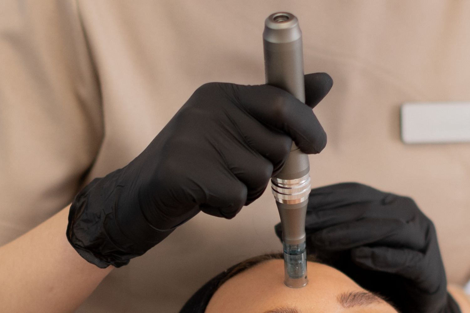 Microneedling