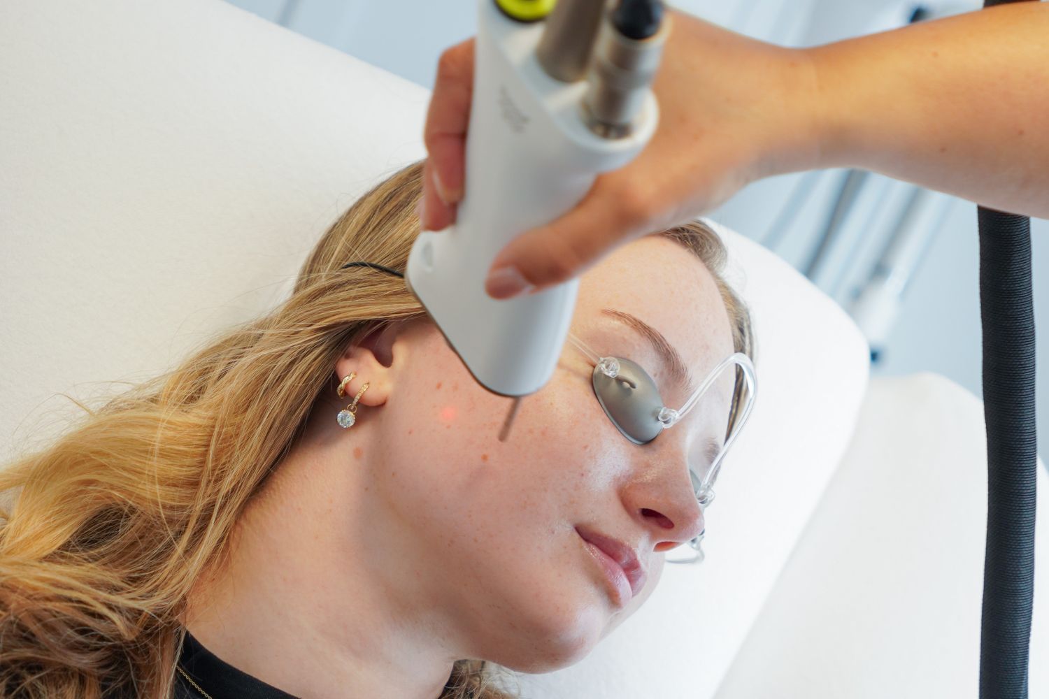 Laser acnetherapie