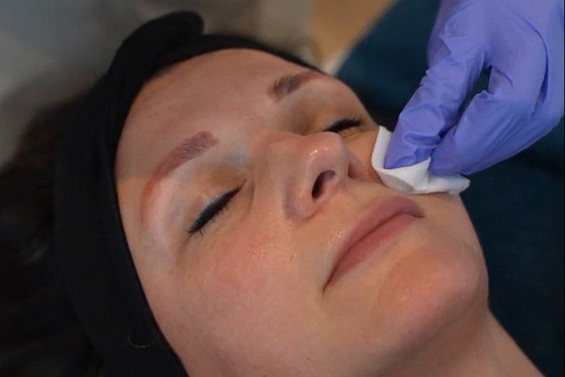 Huidverbetering chemische peeling