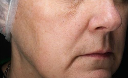 Rustiger, egalere huid na non-ablatieve laser