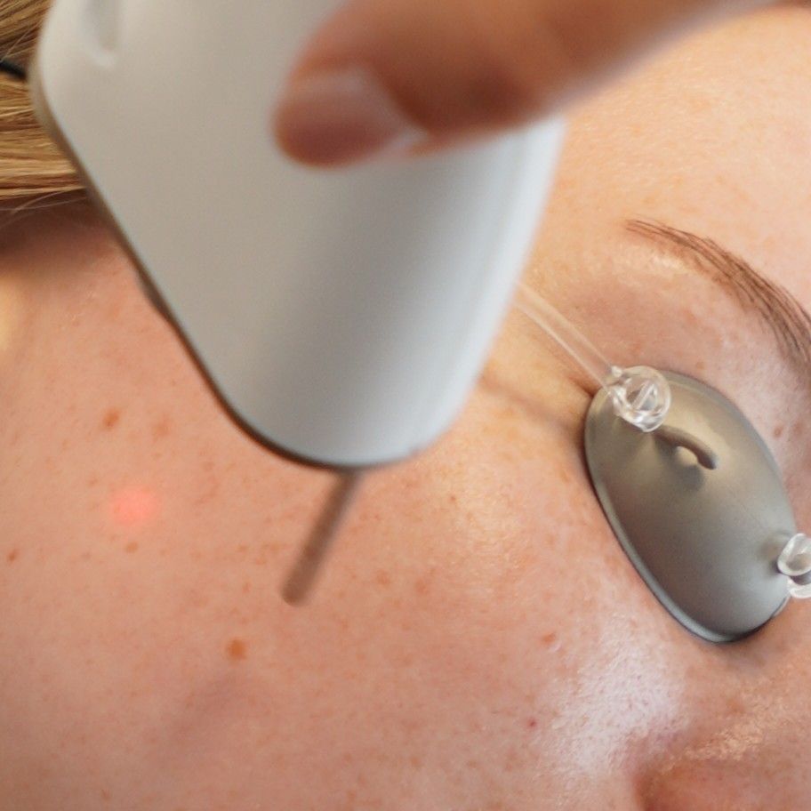 Acné laserbehandeling
