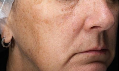 Huid met roodheid of ongelijkmatige teint voor non-ablatieve laser