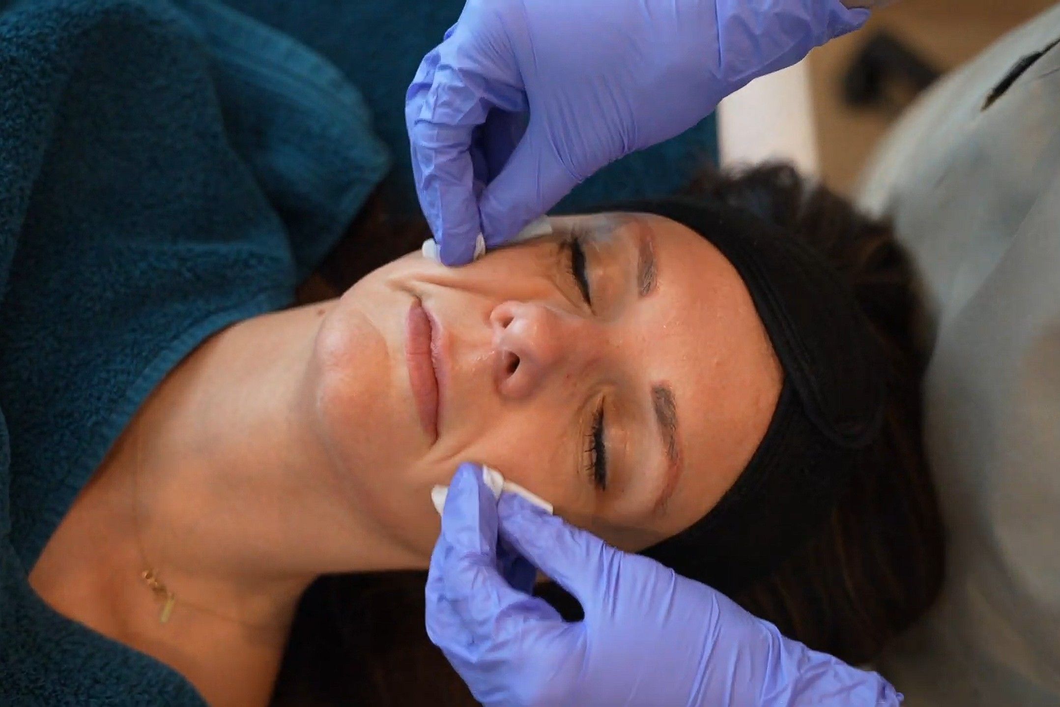Chemische peeling