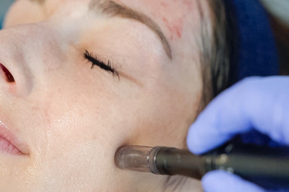 Vrouw die een microneedling‑behandeling krijgt bij Karen