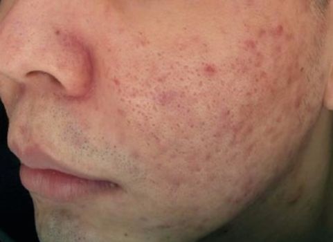 Rode, ontstoken acne op wangen en kin vóór laserbehandeling