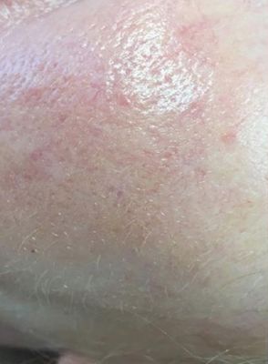 Zelfde zone na behandeling, huid egaal zonder rood spinnetje