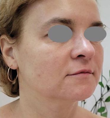 Steviger middengezicht en zachtere plooi na Fotona 4D reeks Portret arts: Dr. Shabnam Golmarvi met Fotona SP Dynamis laser in de behandelkamer