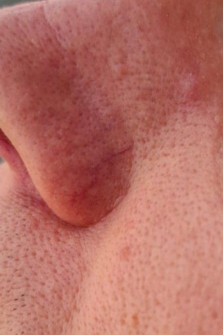 Close-up van neus met klein rood spinnetje voor laserbehandeling
