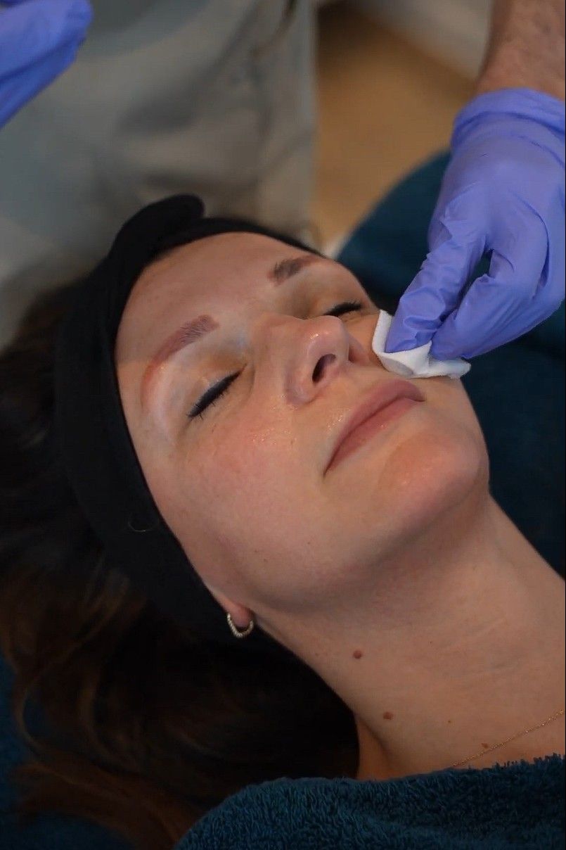 Chemische peeling