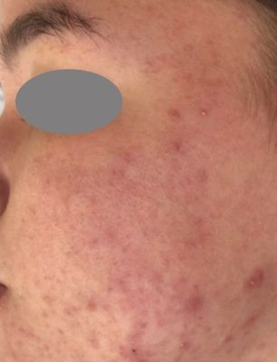 Close‑up van wangen met ingedeukte acne littekens en grove poriën